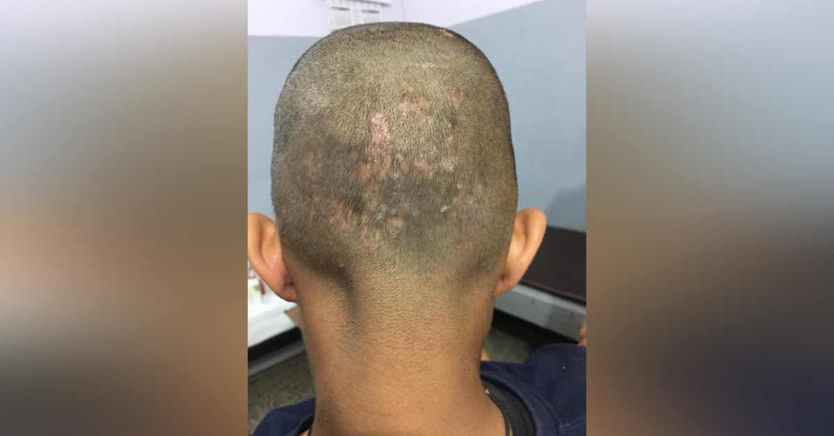 Why Does Fungal Infection Reoccured Over Scalp After One Year?