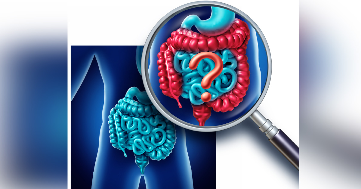 Irritable Bowel Syndrome: Can You Ace This Quiz?
