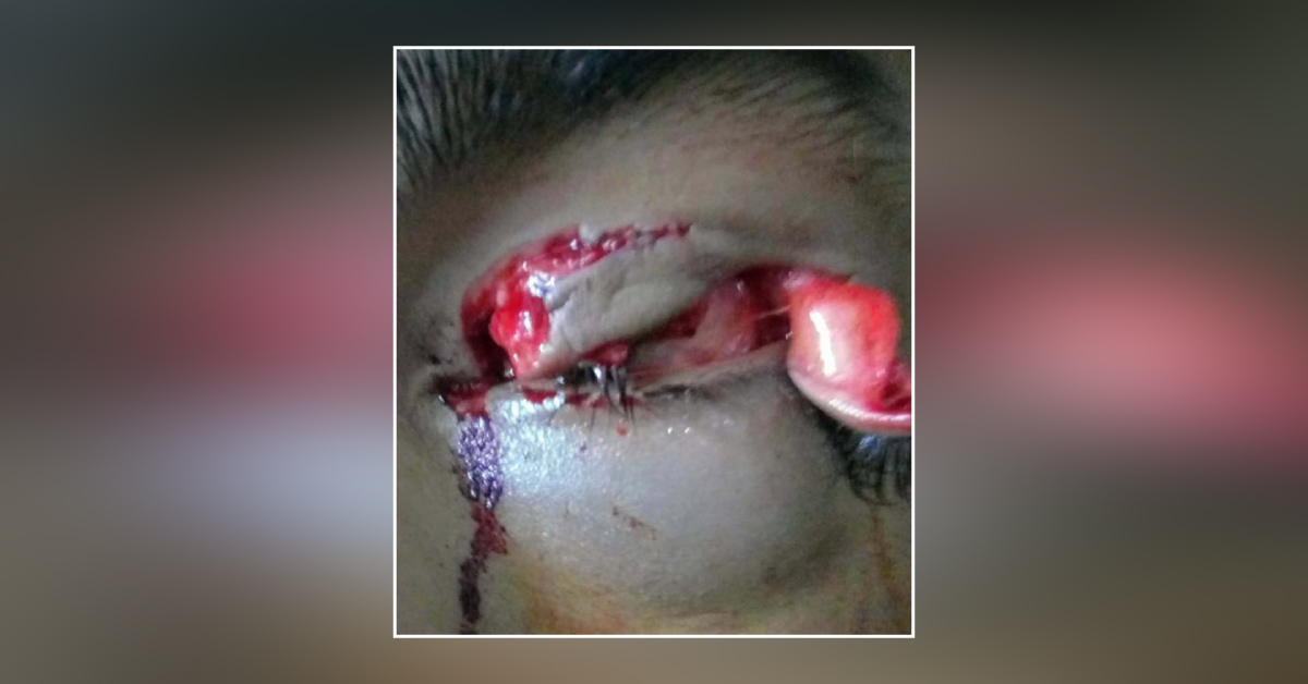 Traumatic Residual Ptosis