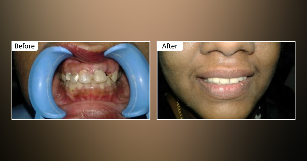 Broken, Discoloured Teeth? All You Need Is A Smile Makeover