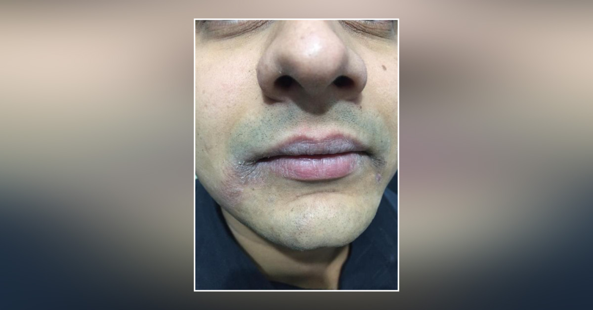 What is this angular lesion in a young?