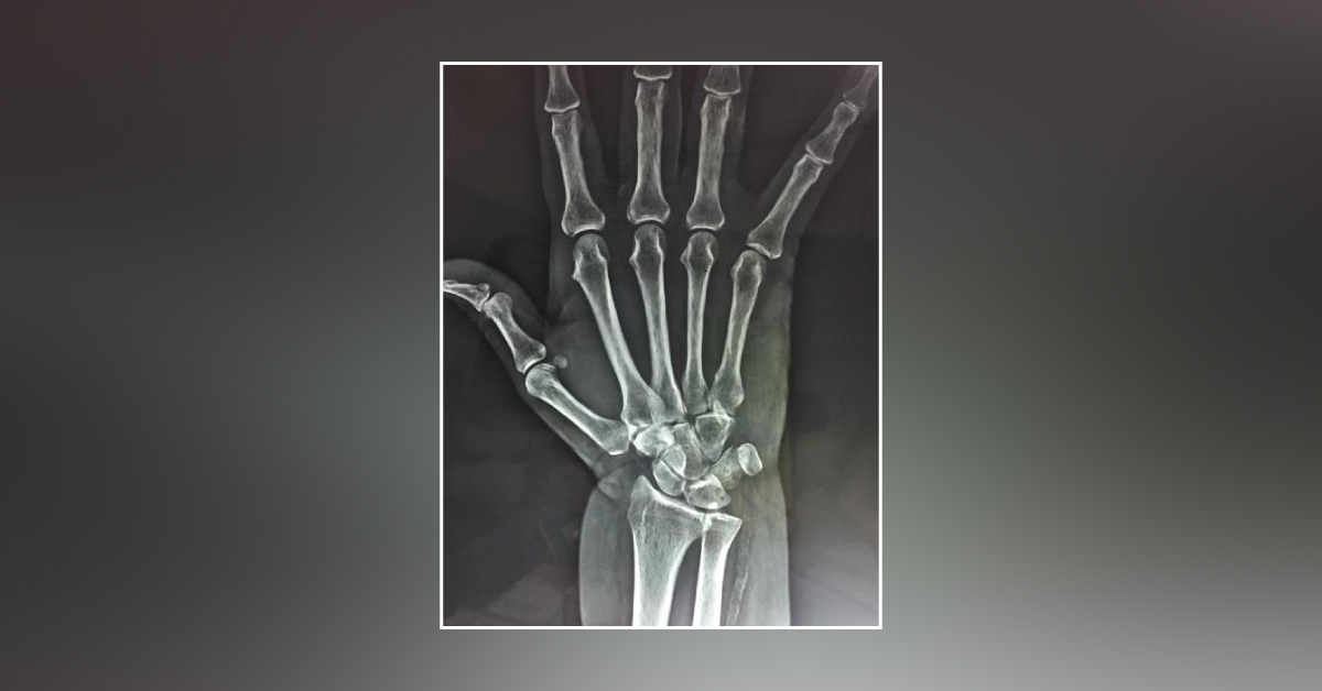 What are these tiny lytic lesions in carpel bones of wrist?