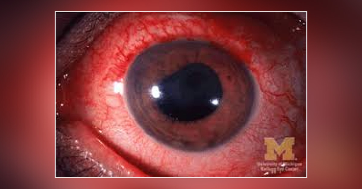 Causes Of Bilateral Granulomatous Panuveitis