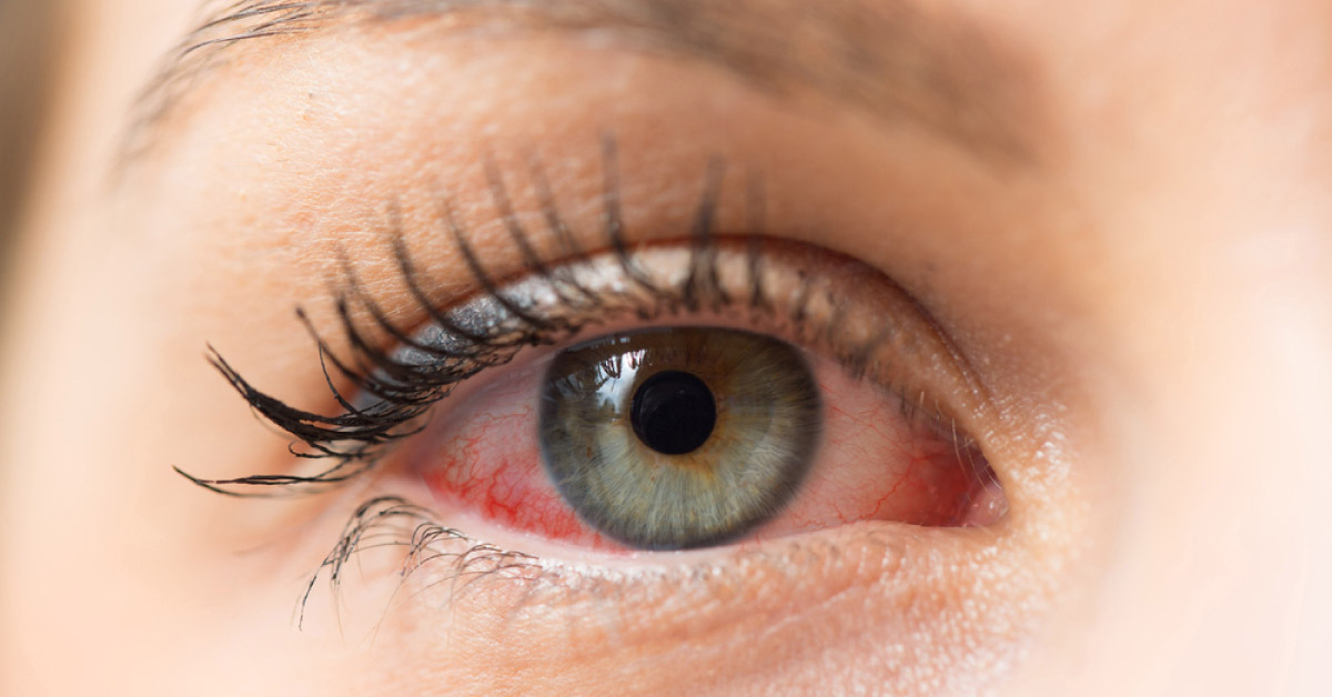 Rare Severe Completions Of Pterygium Surgery