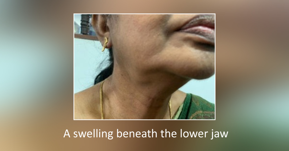 Sialolithiasis – story of the salivary stone