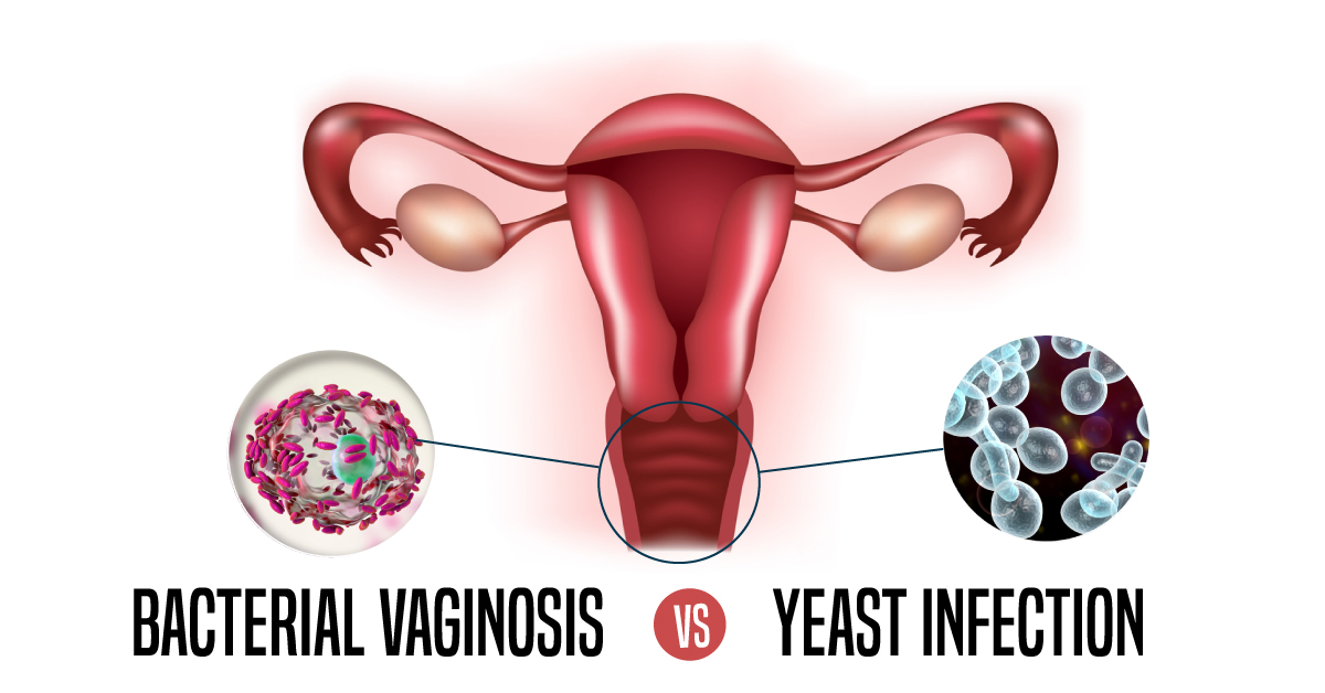 Bacterial Vaginosis Vs Yeast Infection