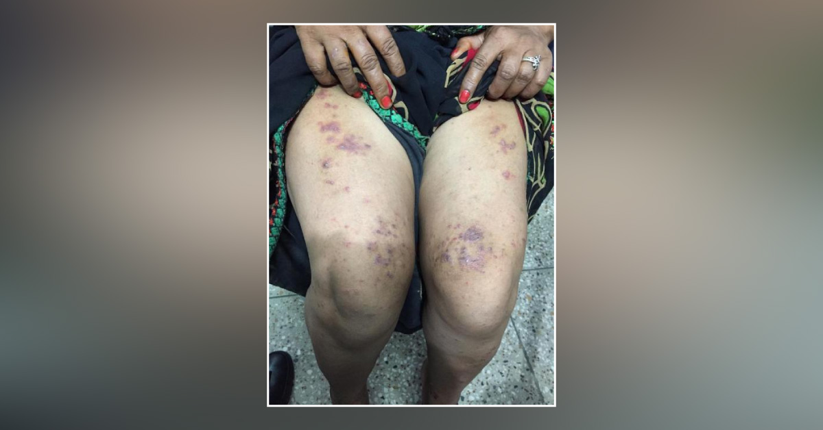 How To Treat This Skin Condition? 