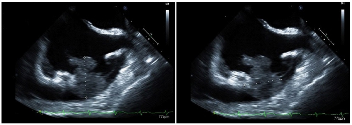 Flu, Left Shoulder Pain, Malaise, Shortness of Breath: What Is the Cause of These Symptoms?