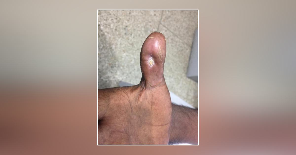 What Is The Cause Of Recurrent Abscess In Thumb?
