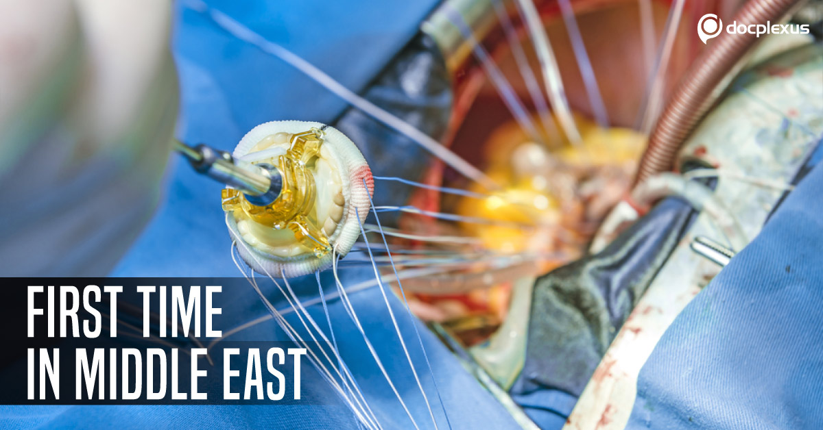 Rare Valve Replacement Surgery At Kuwait Chest Hospital