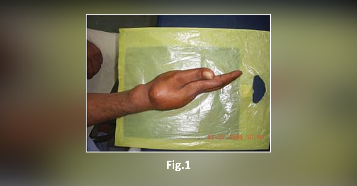 A Man with a Painless Mass in the Hand: What can be the Diagnosis?
