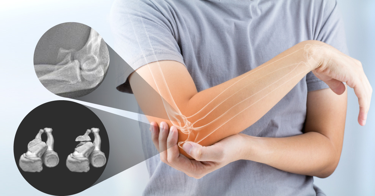 Coronoid Fracture of the Elbow: A Rare Critical Injury