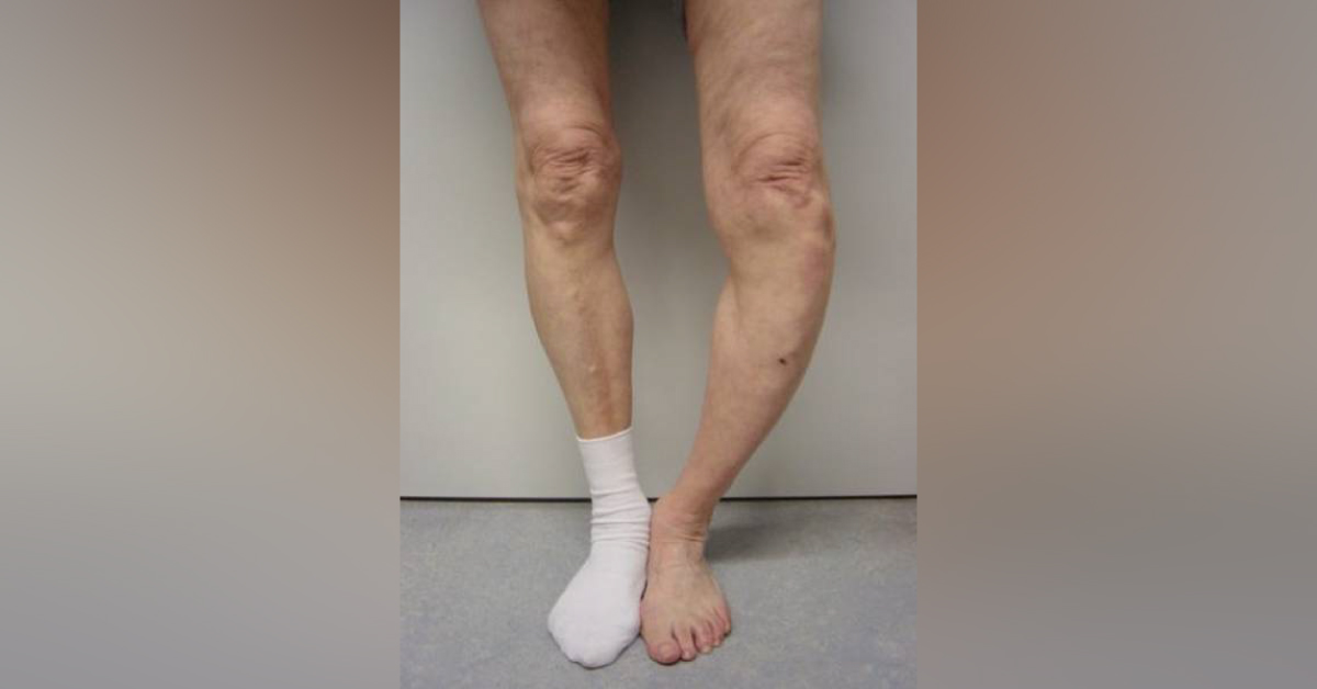 Ocular Manifestations Of Juvenile Paget’s Disease