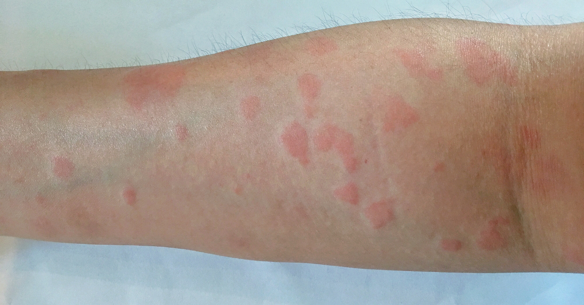 Ocular Manifestations Of Systemic Lupus Erythematosus