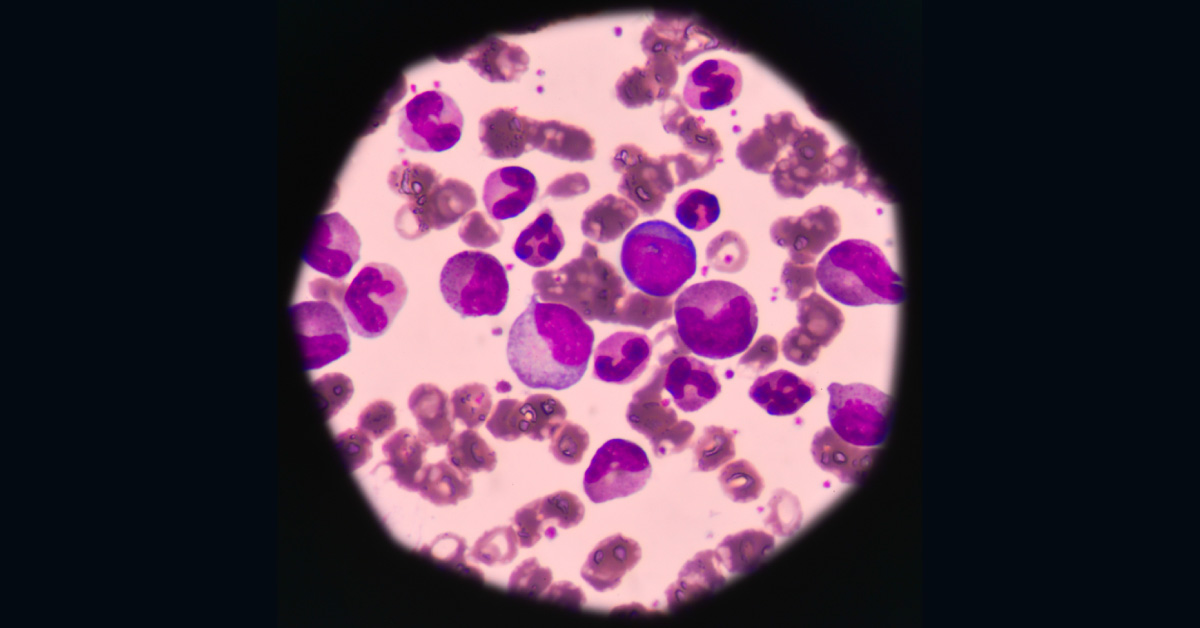 Benefits Of Early Detection Of M351T Mutation, By ASO-PCR