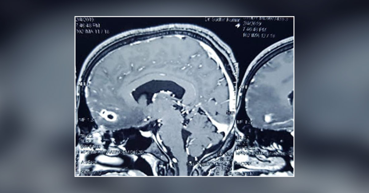 Tuberculoma Versus Neurocysticercosis Brain