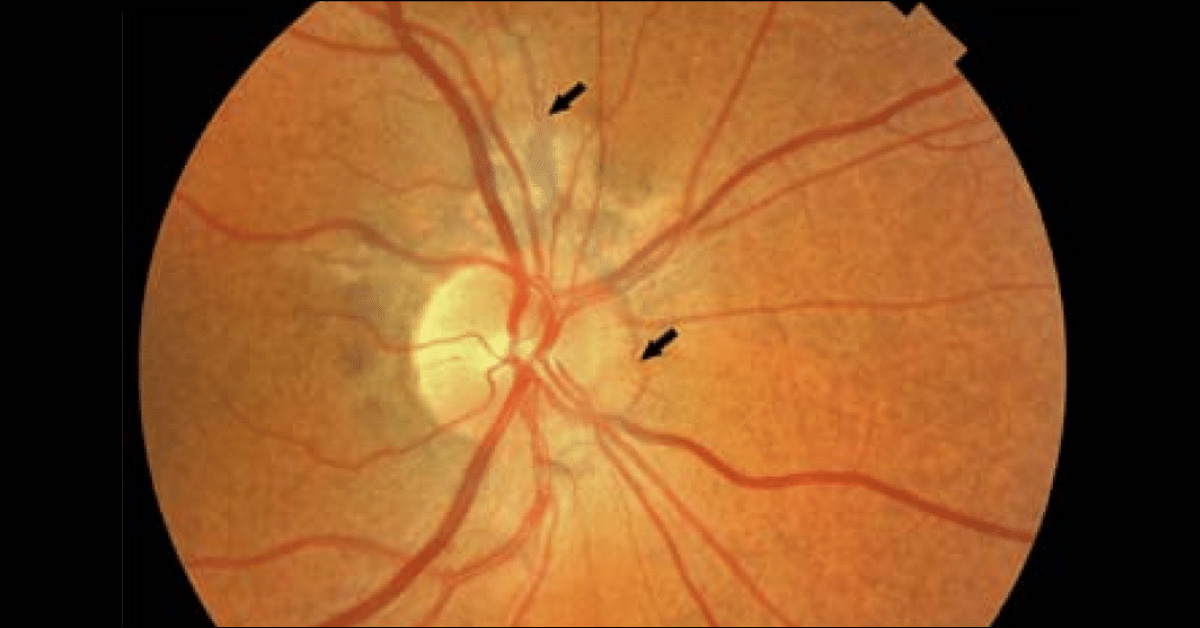 Ocular Manifestations Of Pseudoxanthoma Elasticum