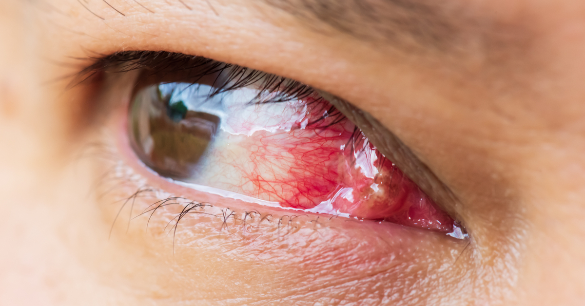 Old And New Surgical Modalities Of Pterygium Surgery