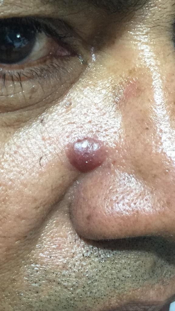What Is This Lesion On Face?