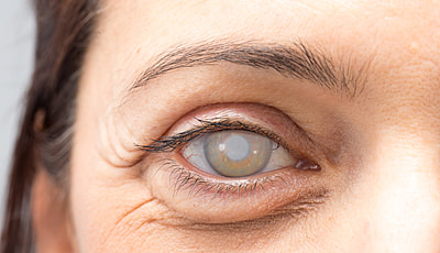 Identify the Reason for Vision Loss