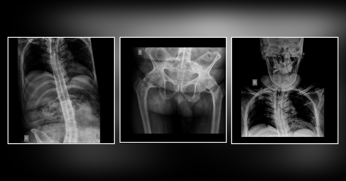 Need of Hip and Spine Treatment
