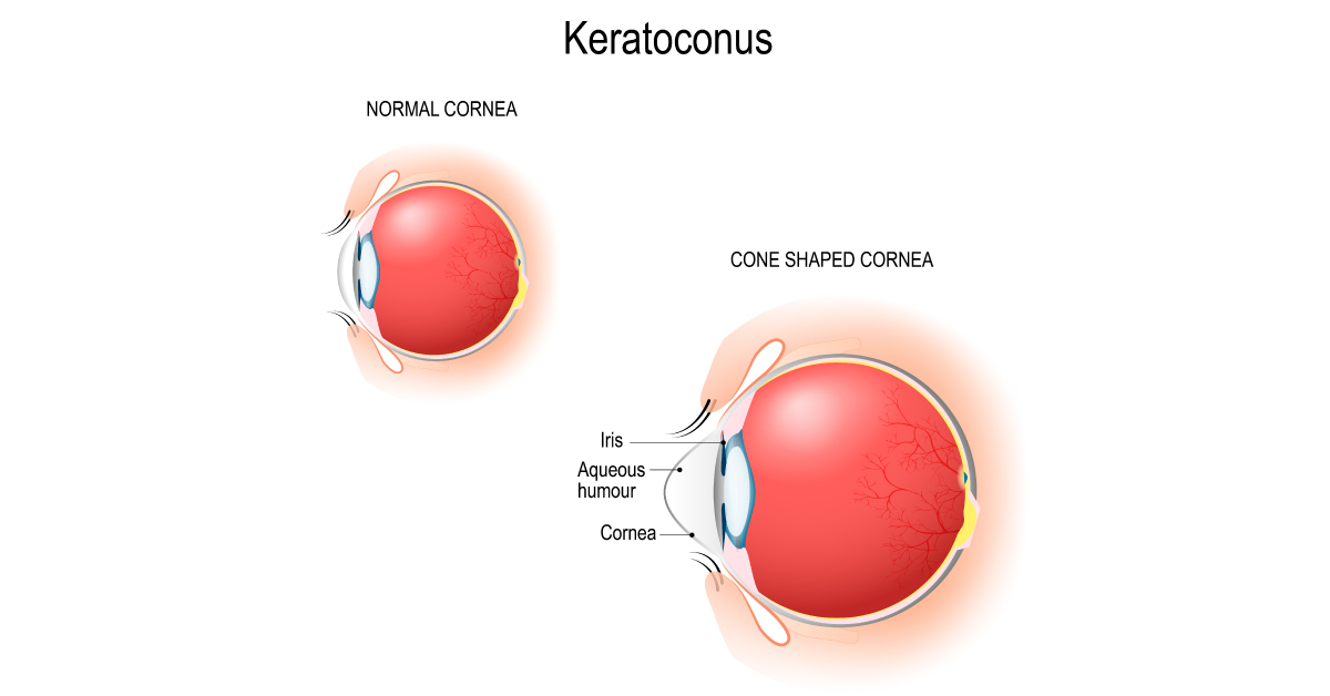 Brief Post On Medical Disorders Associated With Keratoconus