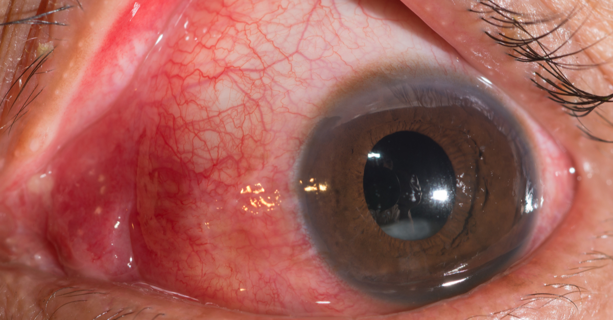 Causes Of Subluxation Or Dislocation Of Lens