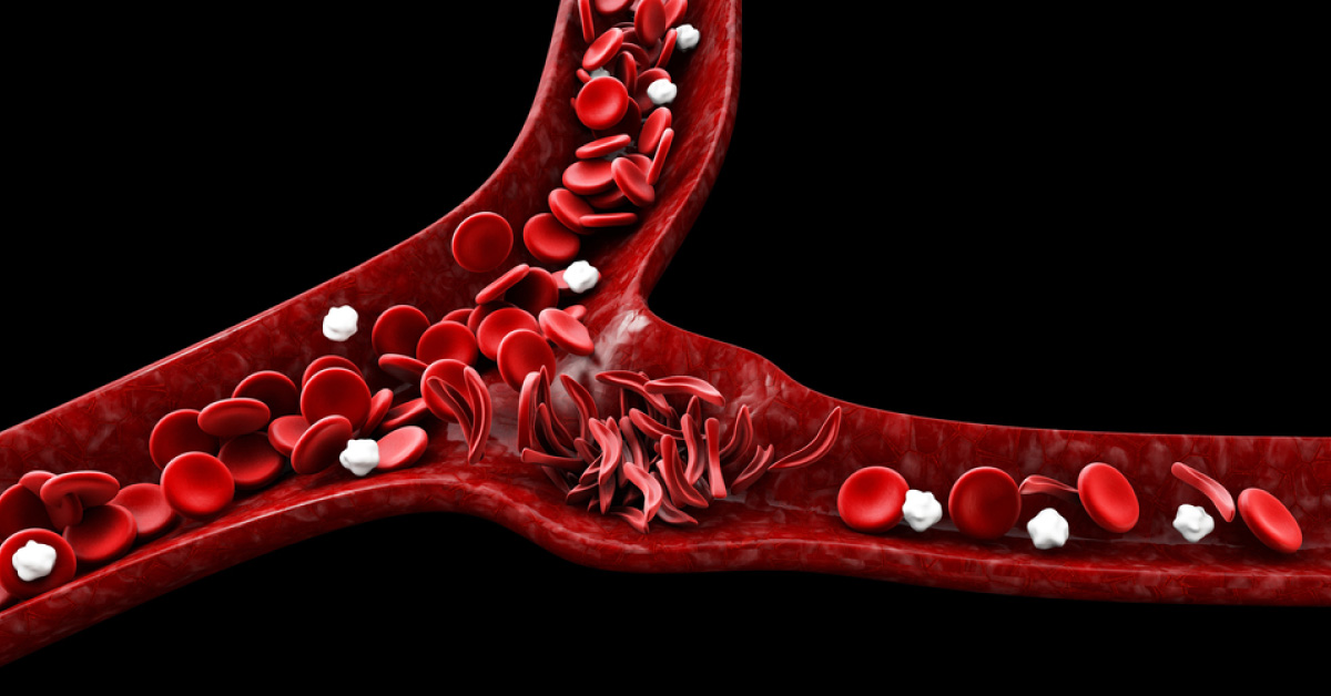 Anterior And Posterior Segment Manifestations Of Sickle Cell Disease