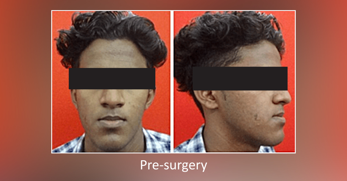 A Case Of Correction Of The Habsburg Jaw
