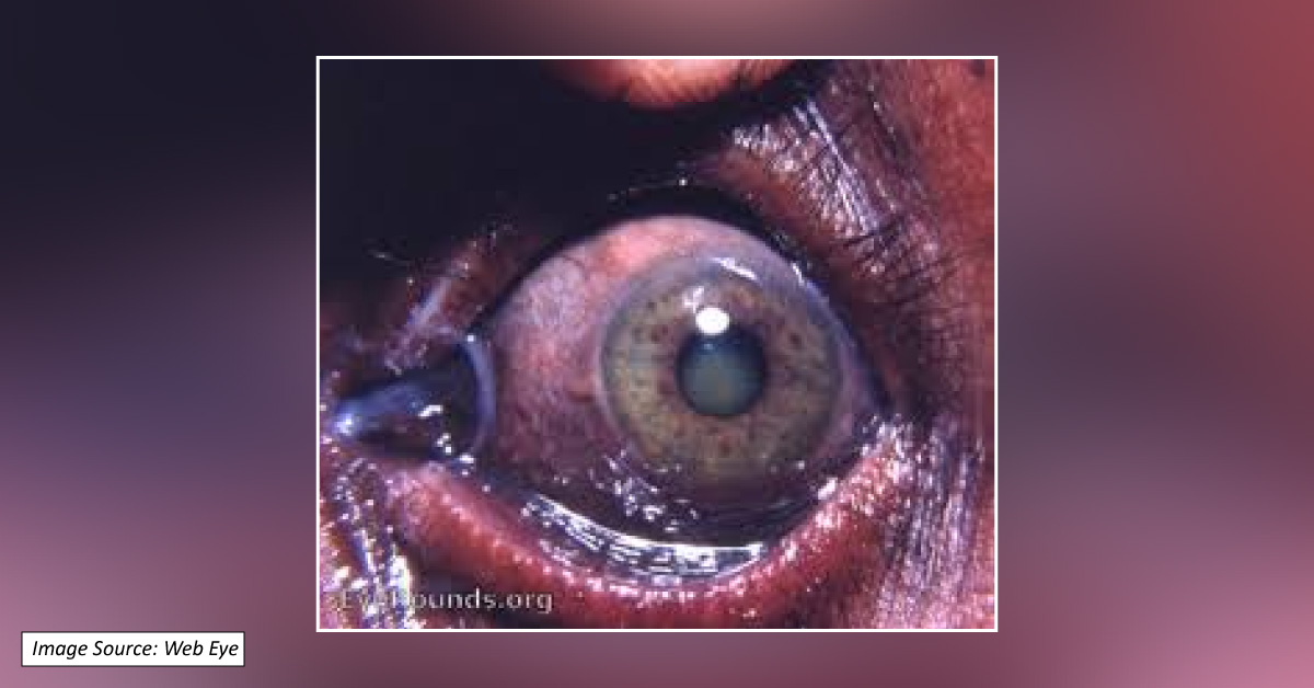 Occular Defects Due To Retained Iron, Copper, Gold