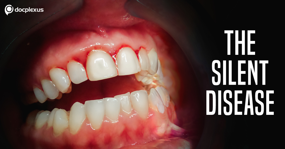 Gingivitis: Outcome of an Unhealthy Oral Practice