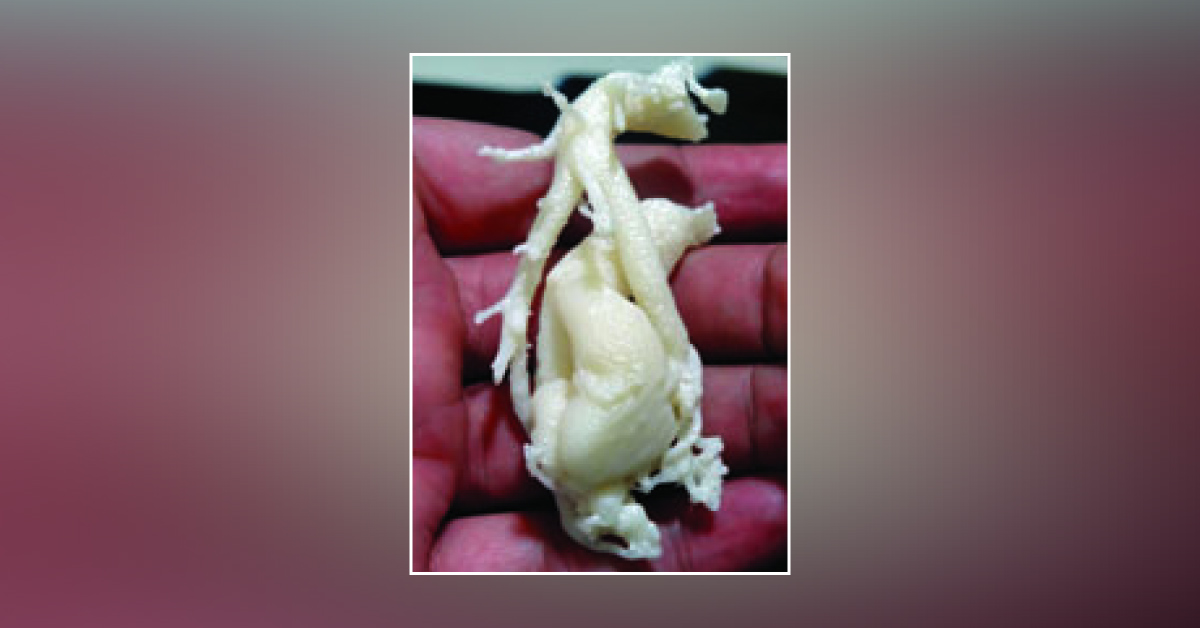 3D Prototype Made The Surgery Easy!