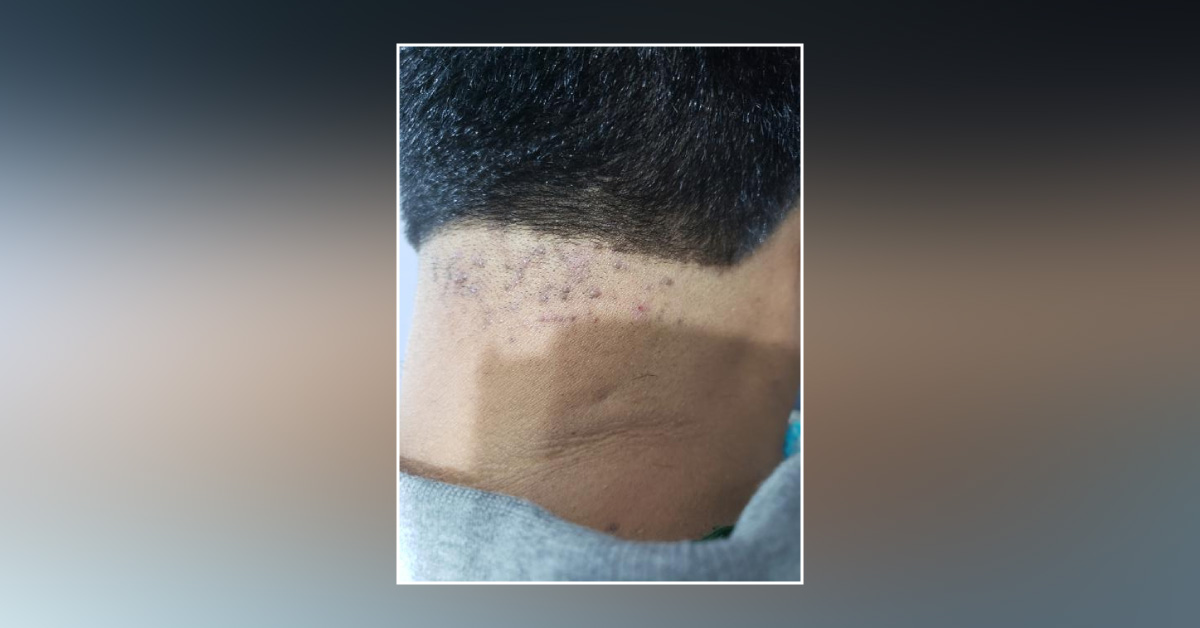 What Are These Skin Lesions?