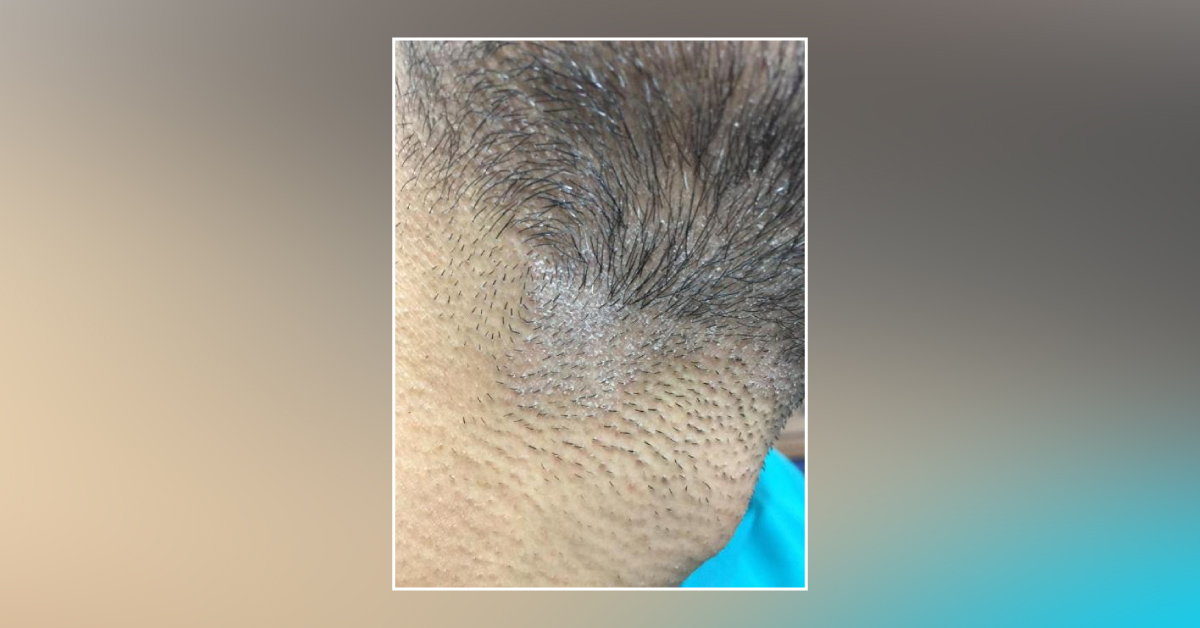 What Is Diagnosis For White Plaques On The Neck?