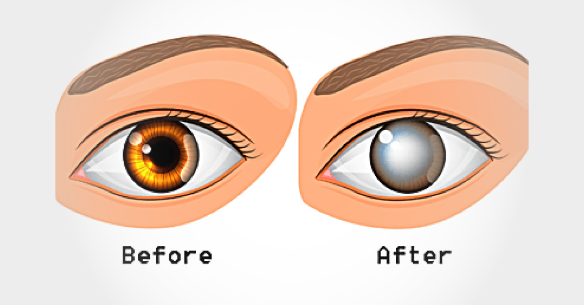 Night Blindness And Its Associations