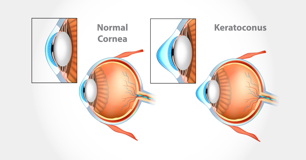 Medical Conditions Associated With Keratoconus
