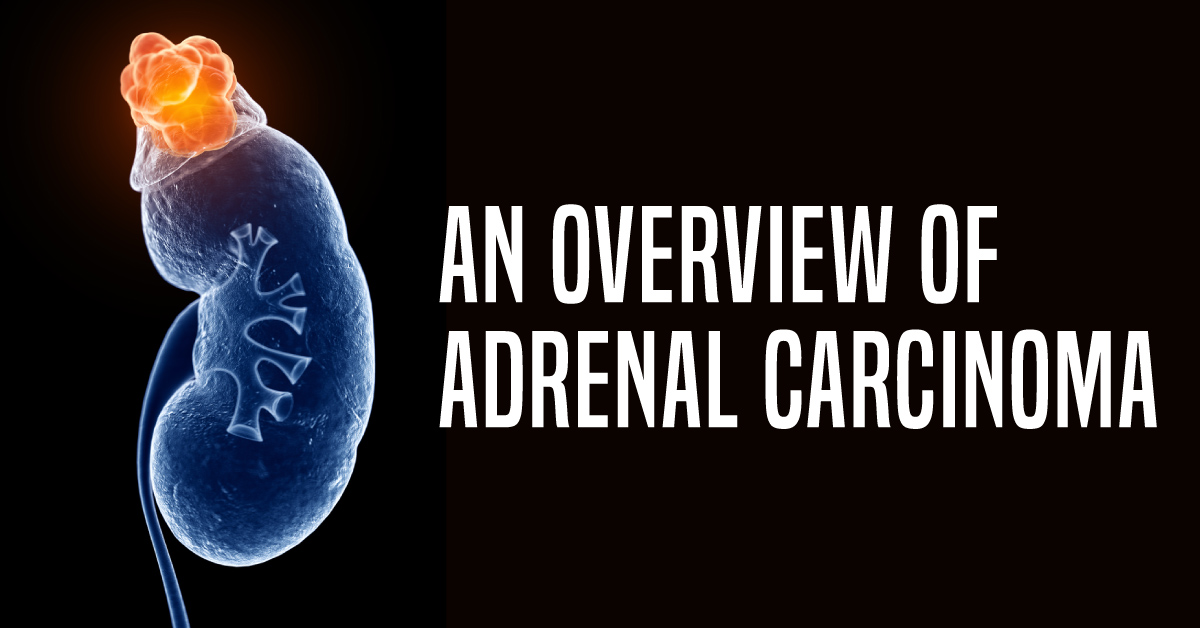 Adrenal Carcinoma And Its Clinical Course