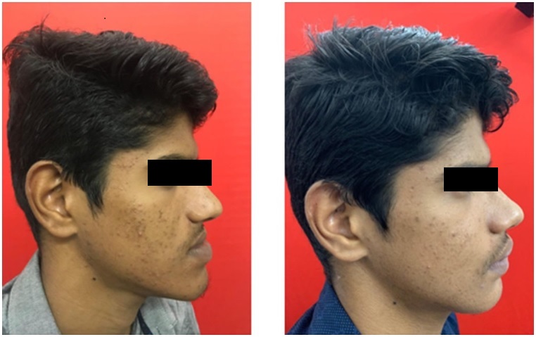 Orthognathic Surgery: A Transformation