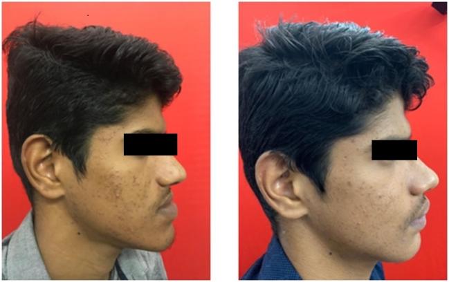 Orthognathic Surgery A Transformation