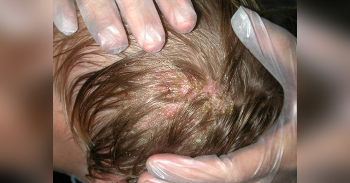 Case of an Infant with Tinea Capitis in the First Year of Life
