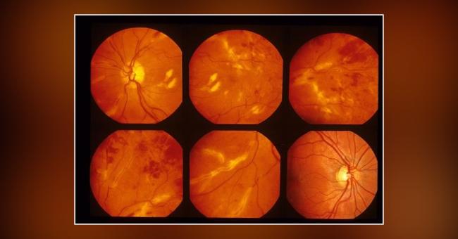 Complications Of Eales Disease