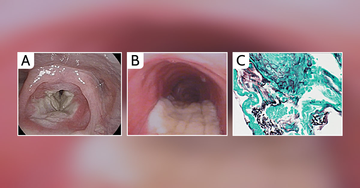 A Case of Opportunistic Infection Following Solid Organ Transplant