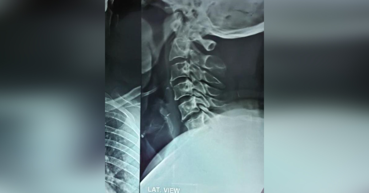 What Are These Lytic Areas In Cervical Vertebrae?