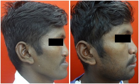 A Case Of Upper And Lower Jaw Deformity