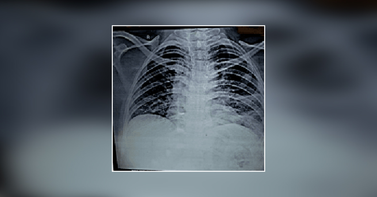 Is There Miliary Tb With Early Plueral Effusion Lt Side?