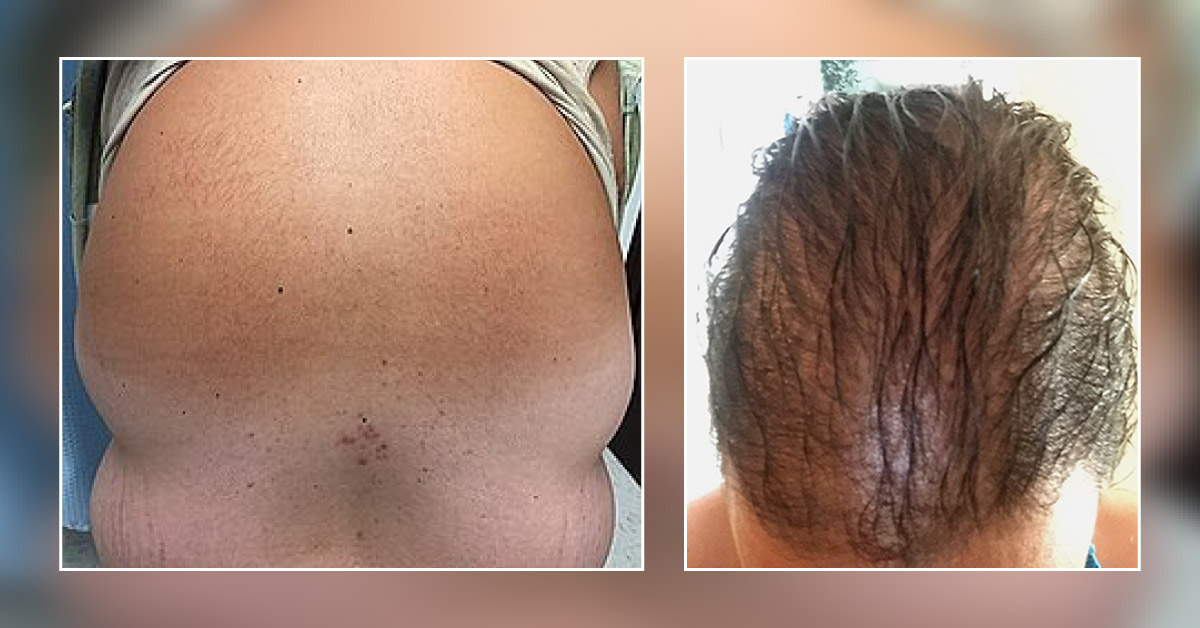 Identify This Condition Causing Hair Loss in a Woman with a History of Obesity and Gastritis