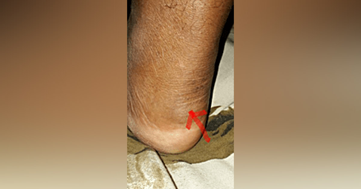What Is In The Rt Ankle?