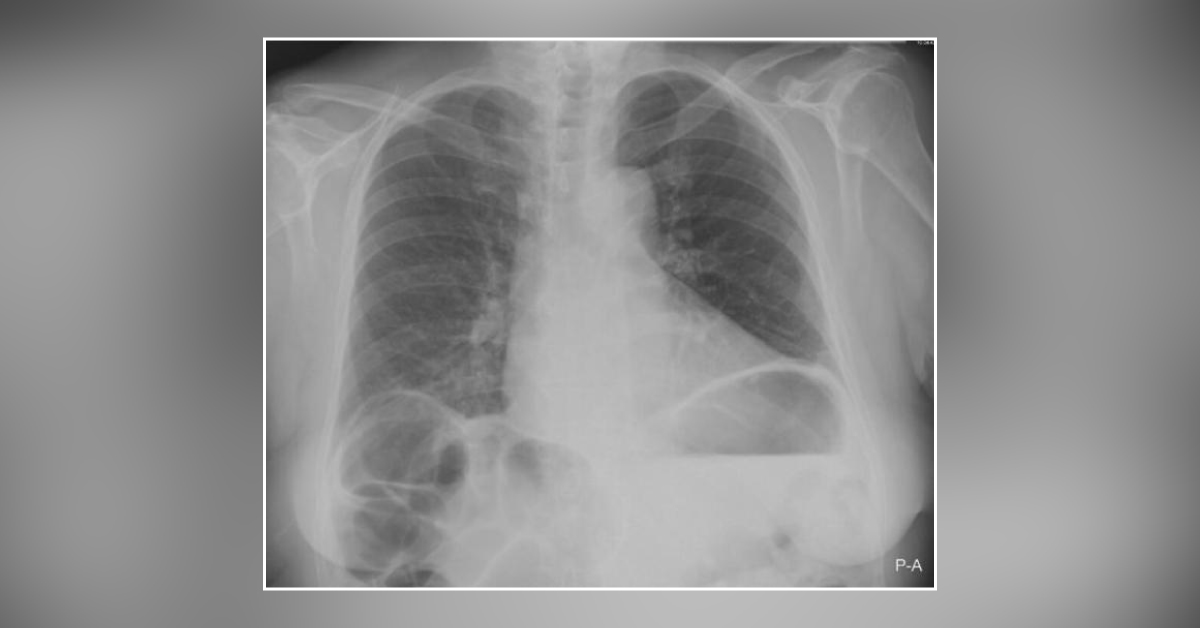 Identify The X-ray Findings