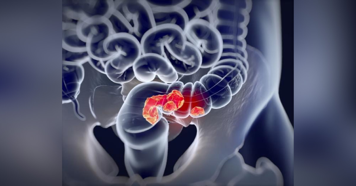 First Trail Vaccine Successful For Preventing Colorectal Carcinoma Cancer And Metastases