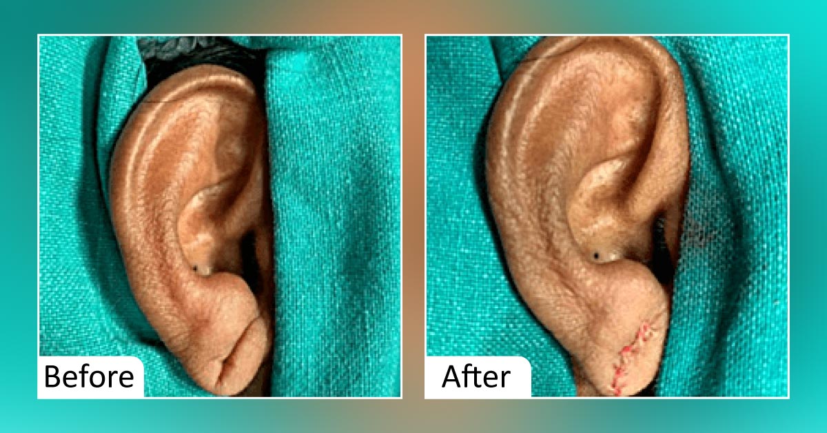 Ripped Ear Lobes? The Solution Is Here